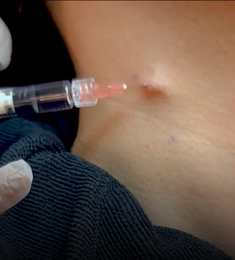 A close-up of a syringe delivering an Aivee Pearl (Profhilo) treatment into the skin